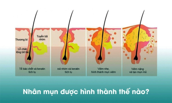 Lấy nhân mụn chuẩn y khoa giá hợp lý - Mun Clinic & Spa