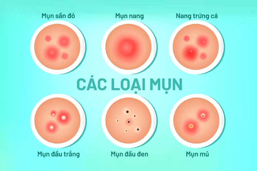 cac-loai-mun-trung-ca-tuoi-day-thi-thuong-gap