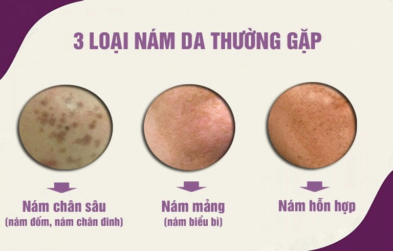 cac-loai-nam-da-thuong-gap